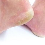 Best Home Remedies For Cracked Heels