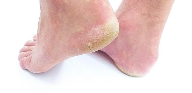 Best Home Remedies For Cracked Heels