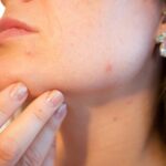 Easy Techniques to Get Rid Of Blackheads