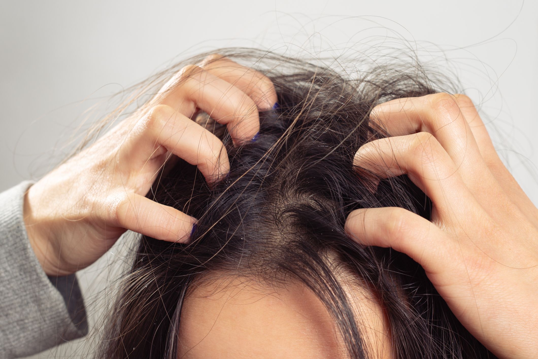 Itchy scalp treatment with basic home remedies