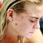 Reasons for Your Horror Story of Pimples