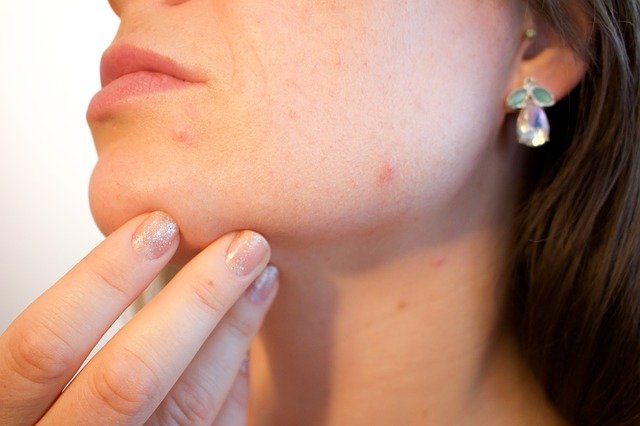 Remedies for Acne Treatment